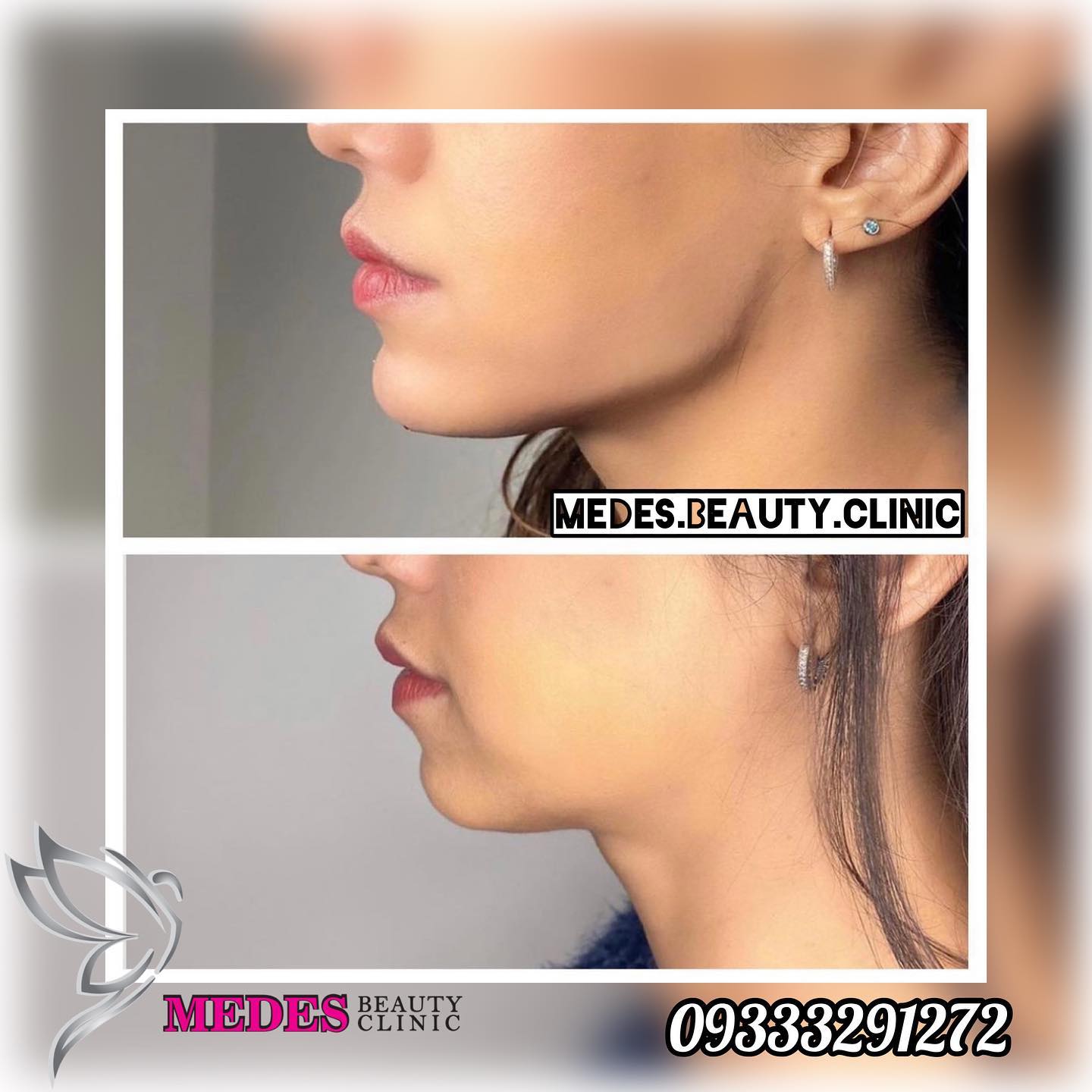 گالری زاویه سازی صورت